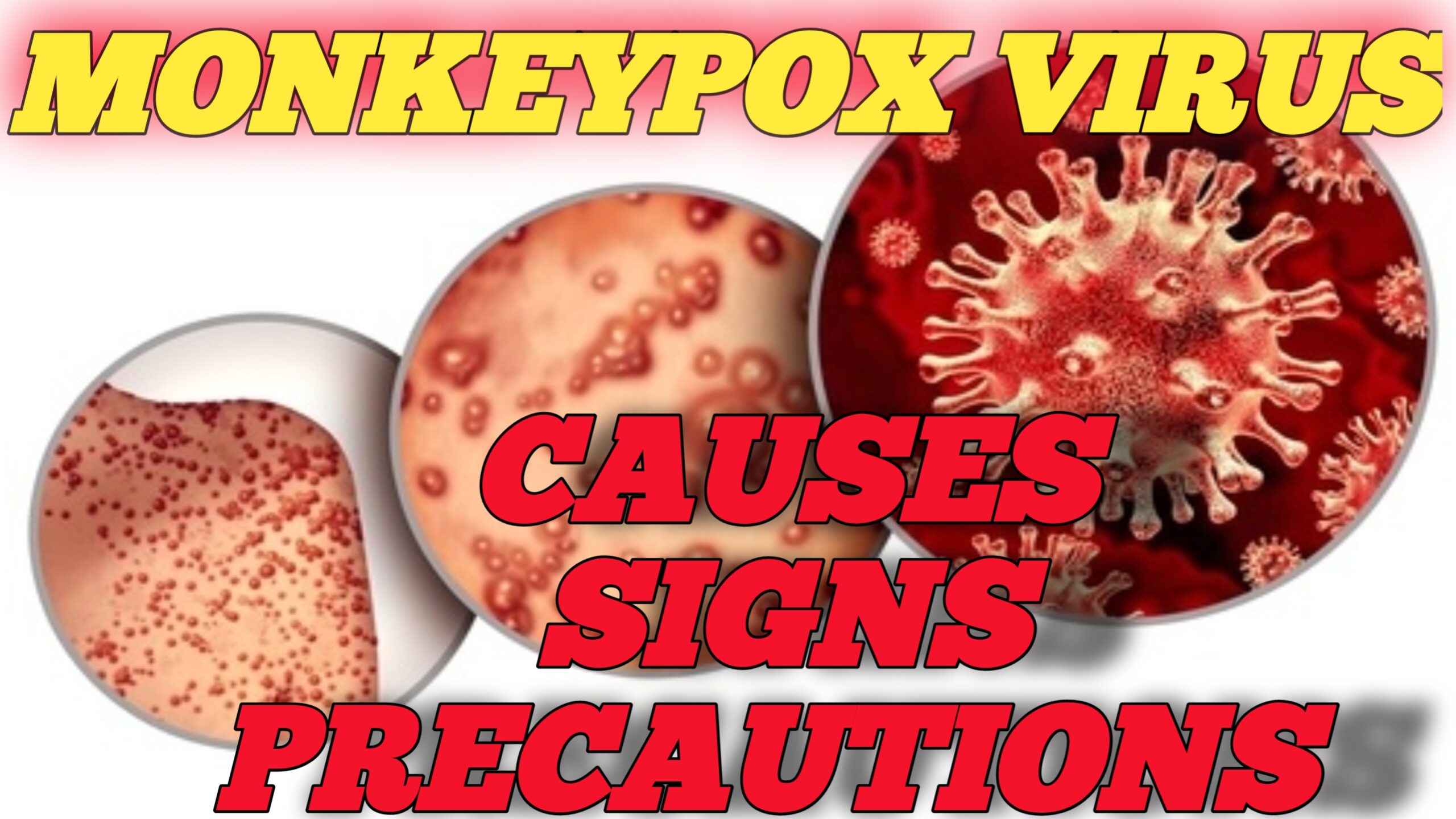 Monkey pox is the new name for panic