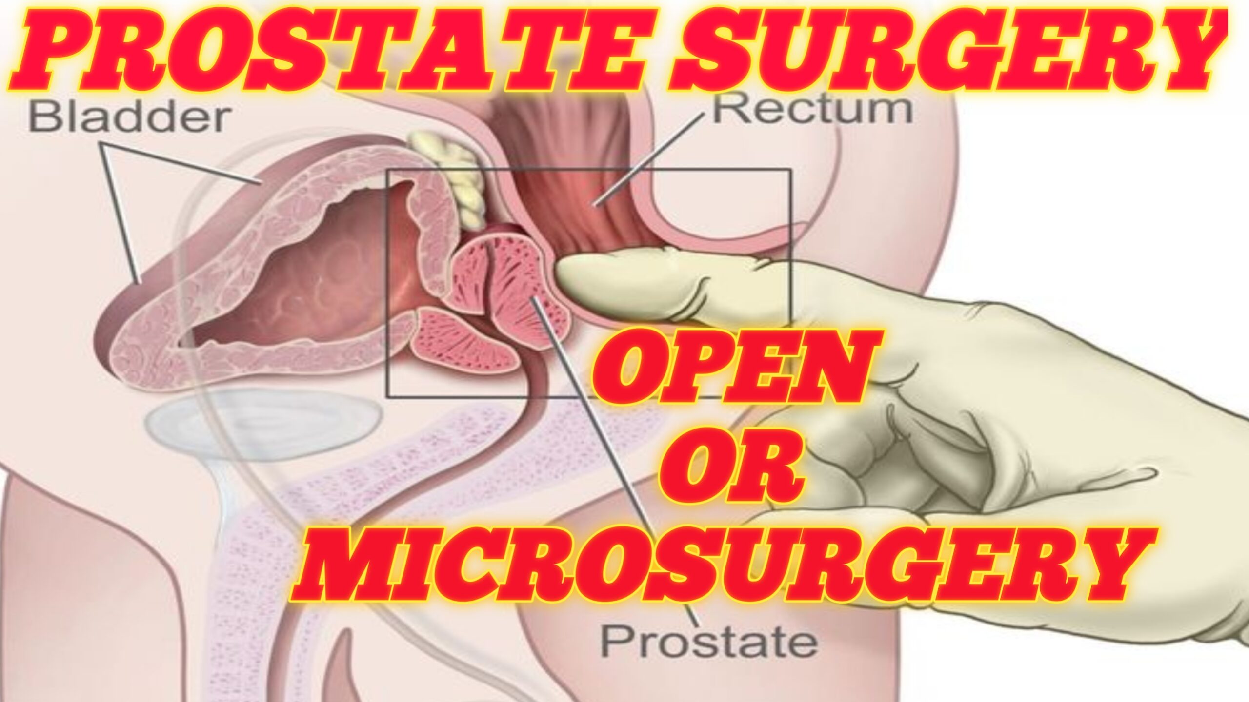 Prostate surgery open or microsurgery?