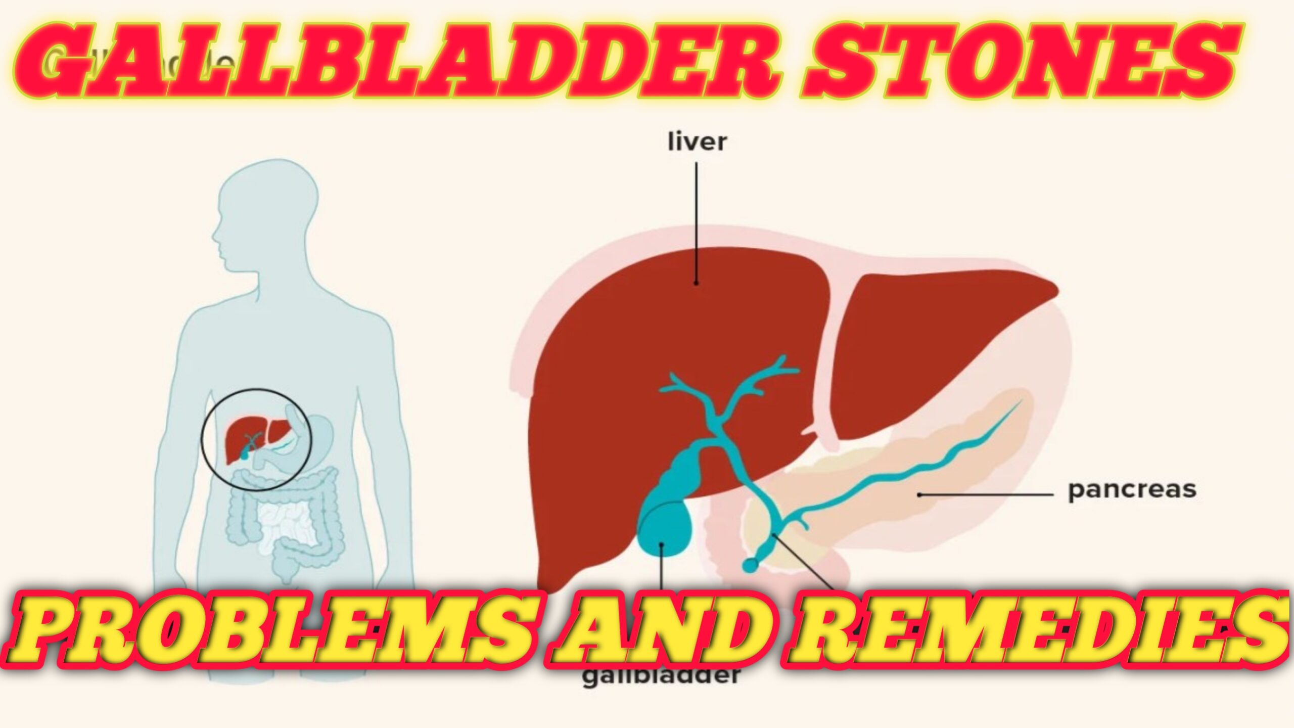 Gallbladder Stones, Problems and Remedies