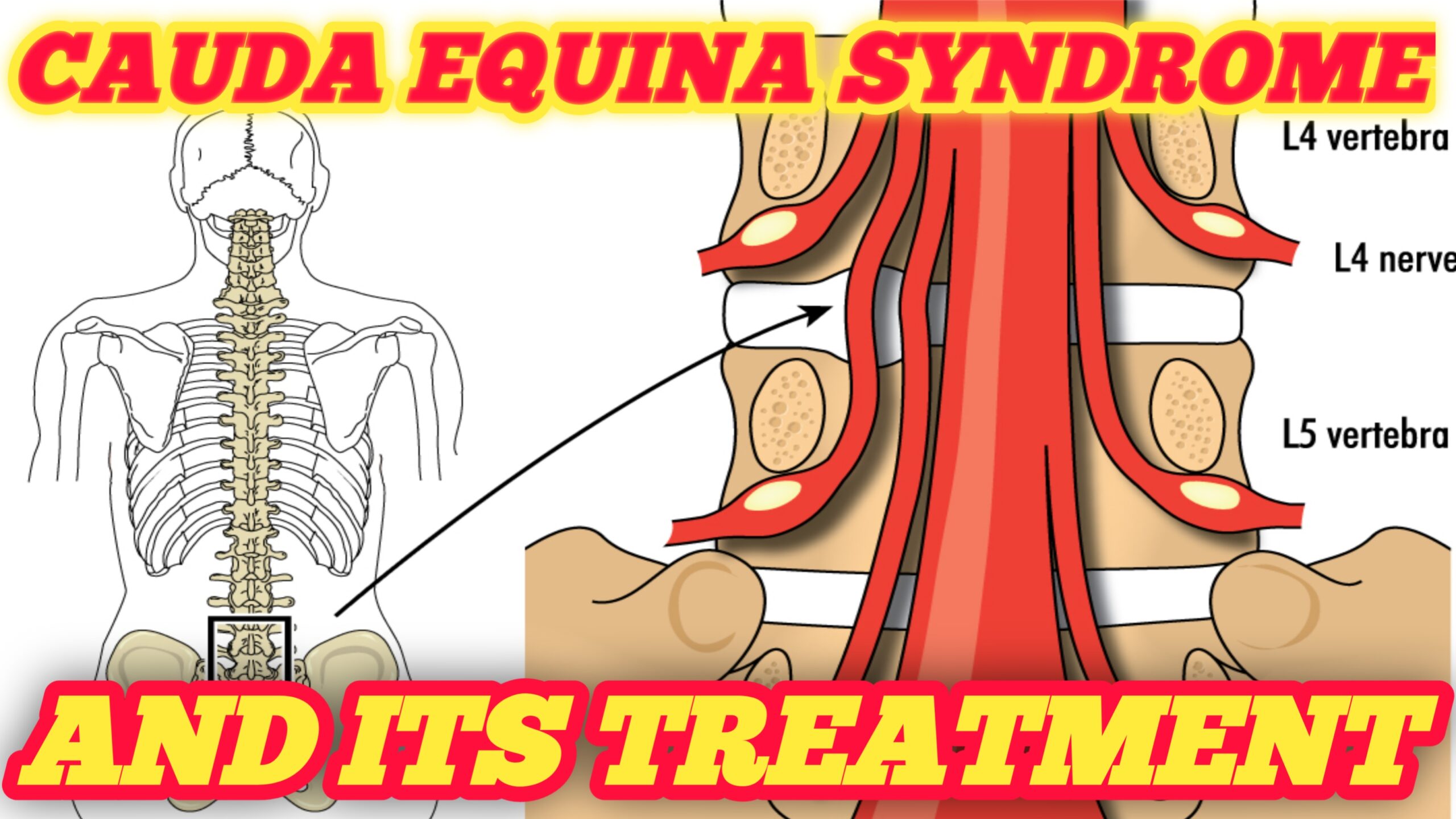 Cauda equina syndrome and its treatment