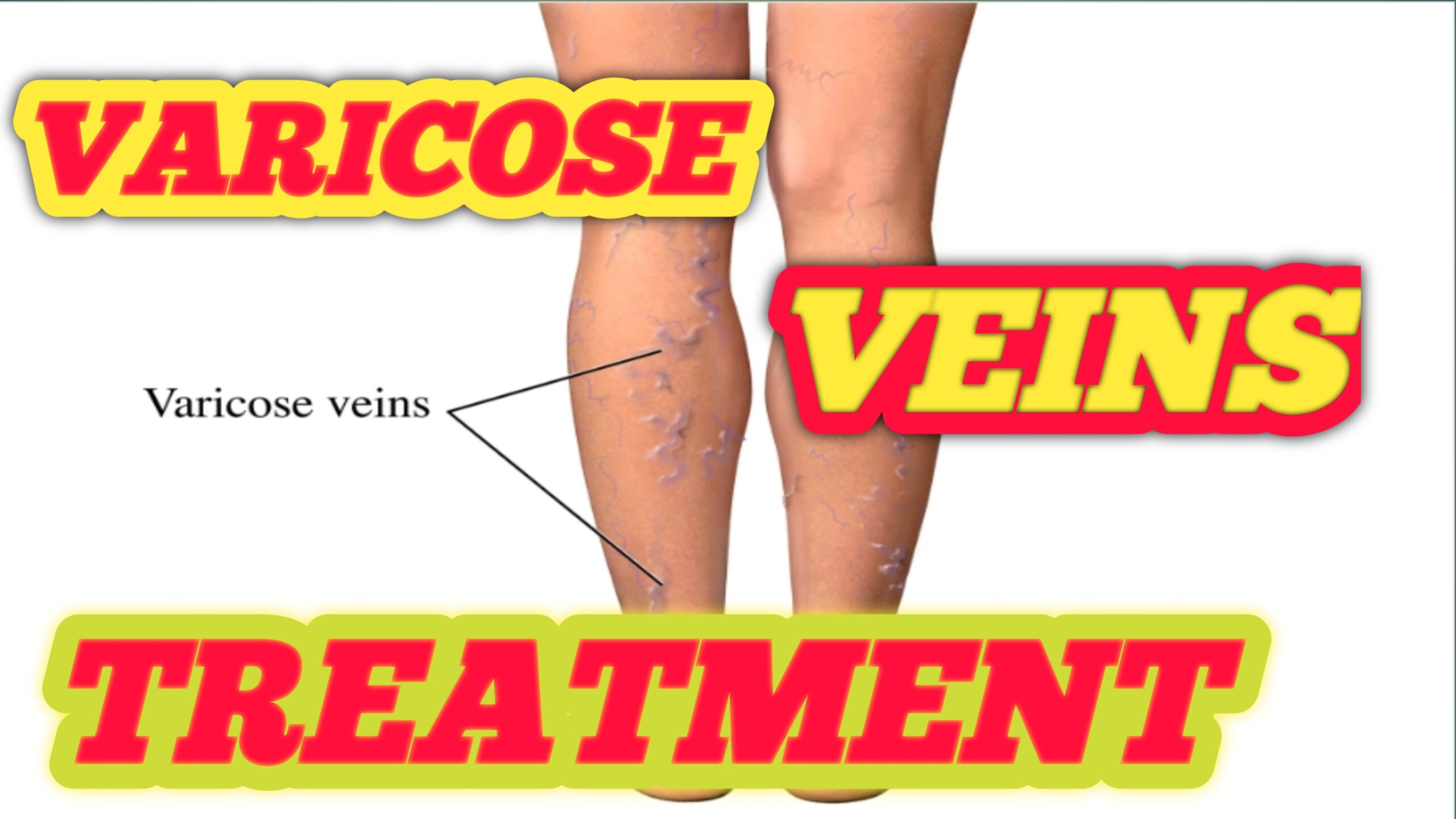 Varicose veins treatment